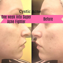 Load image into Gallery viewer, Super Acne Fighter / Organic Acne Treatment / Acne
